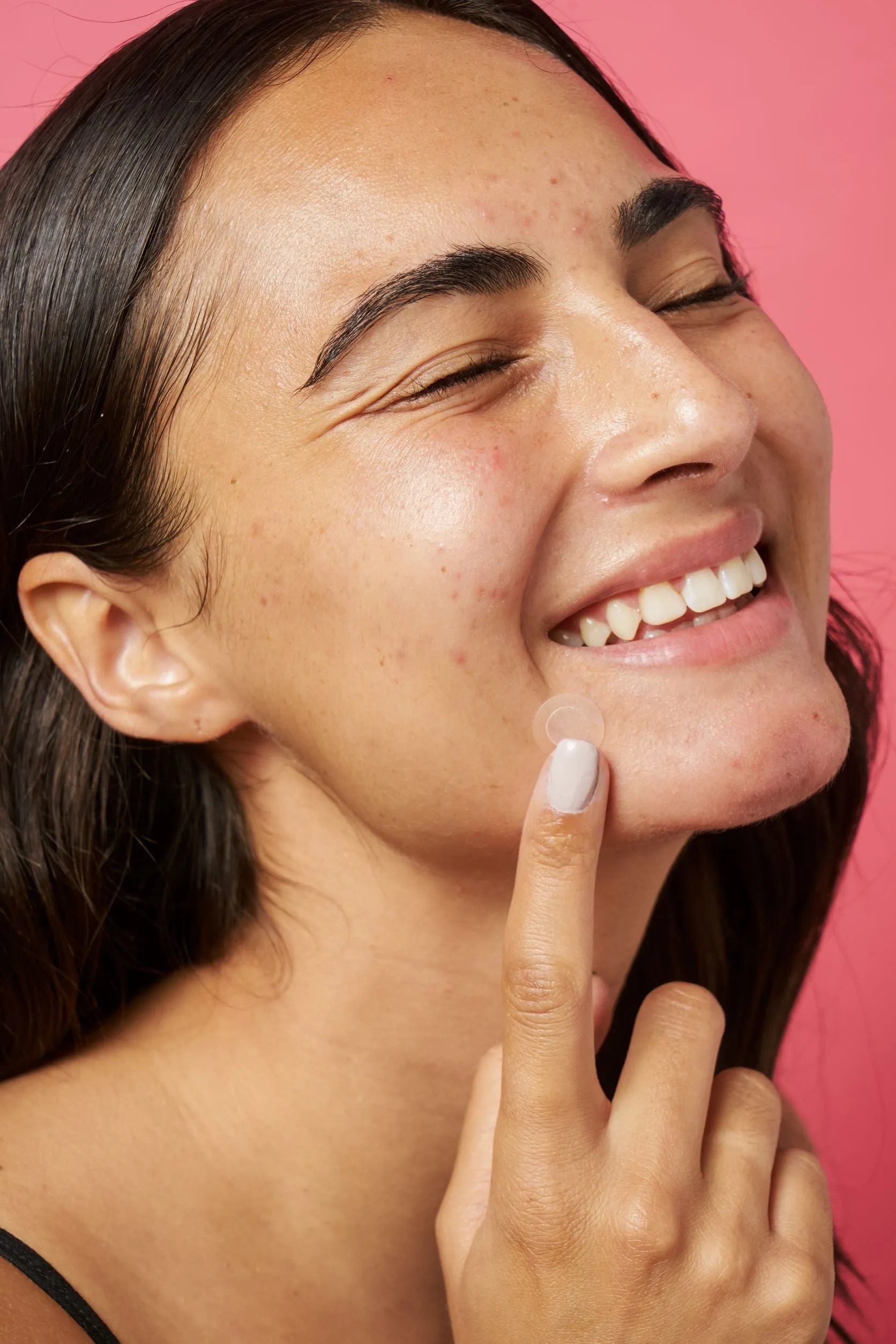 Acne Spot Treatment Trio